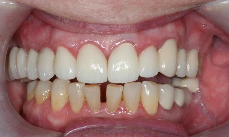 Crowns-After-Image