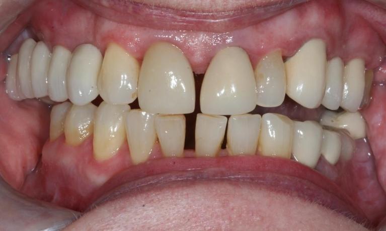 Crowns-Before-Image