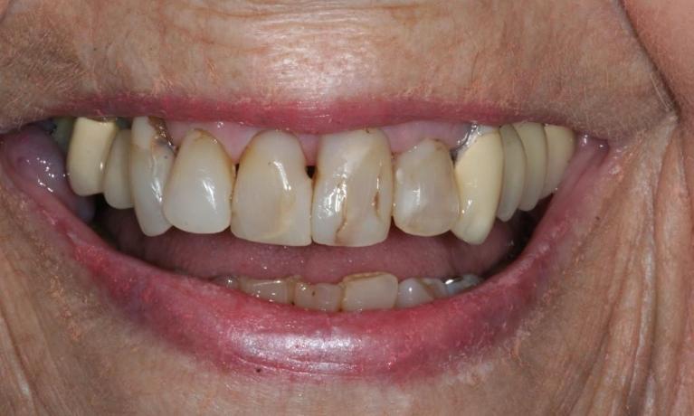 Crowns-Before-Image